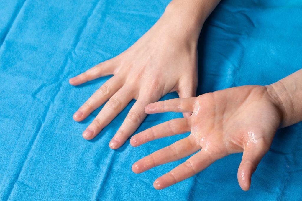 Hyperadrosis Hyperhidrosis Treatment Singapore | Excessive Sweating