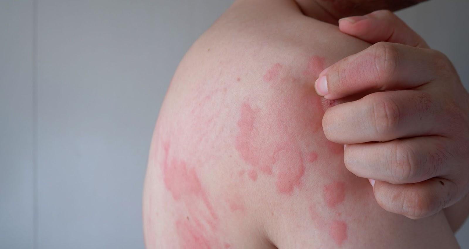 Acne Singapore: Tips for Managing Breakouts Singapore - Livingstone ...
