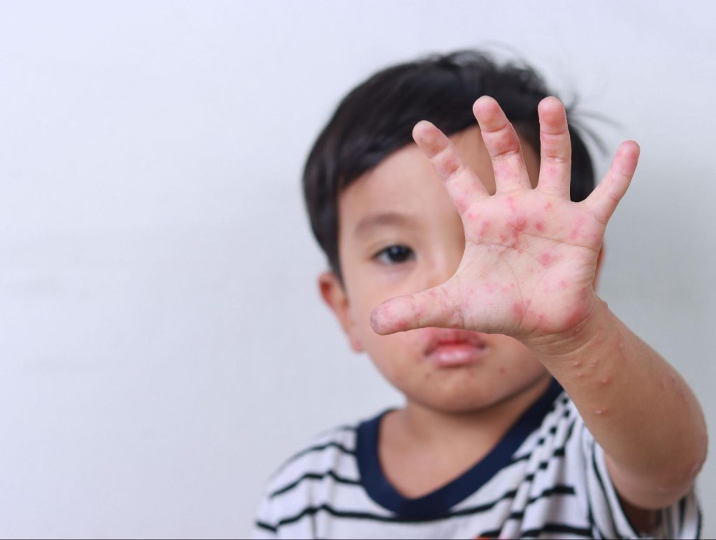 Paediatric Dermatology - Livingstone Dermatology