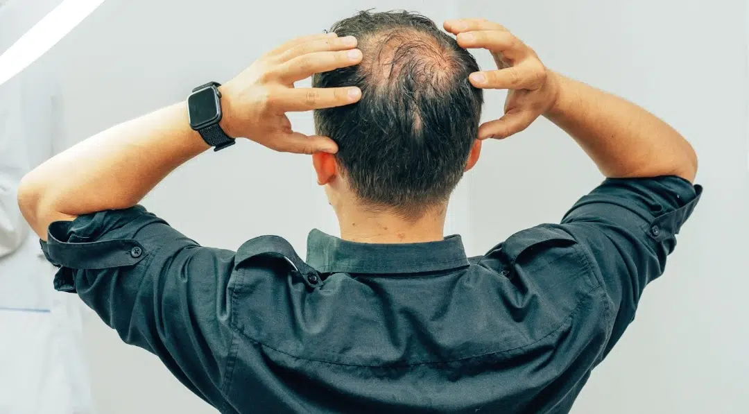 Male pattern baldness in singapore