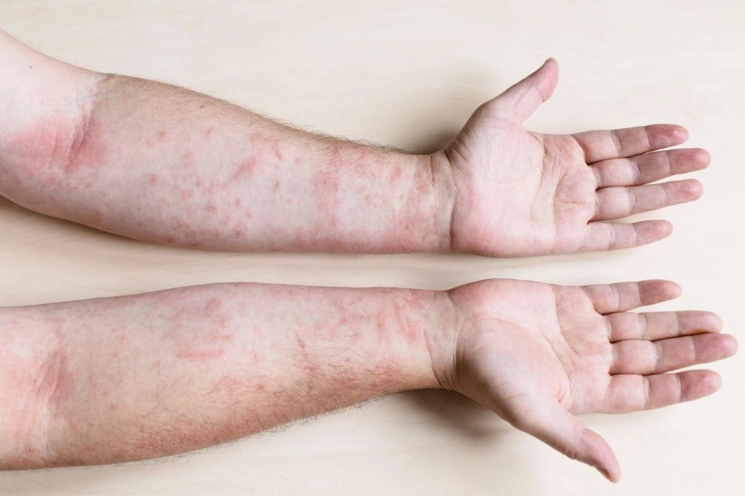 Contact Dermatitis Singapore