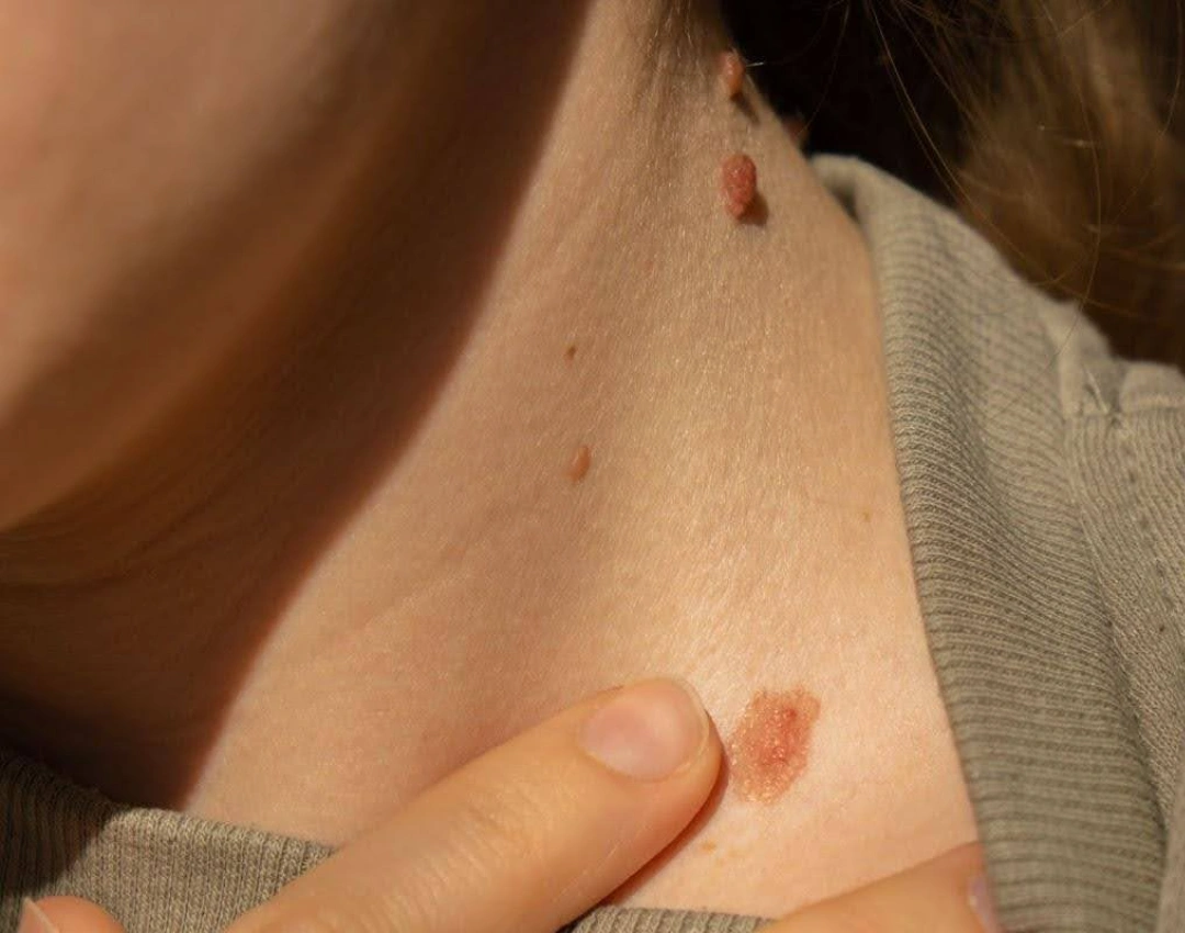 Symptoms of Skin Cancer Singapore