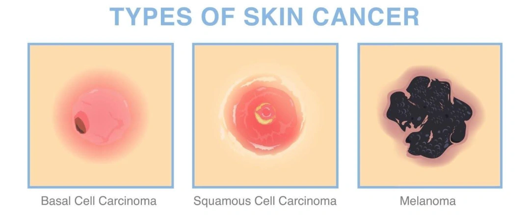 Skin Cancer Singapore