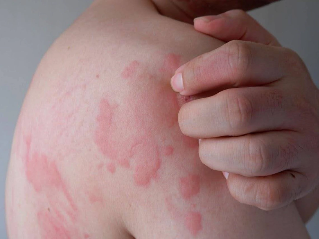 Urticaria Symptoms Singapore