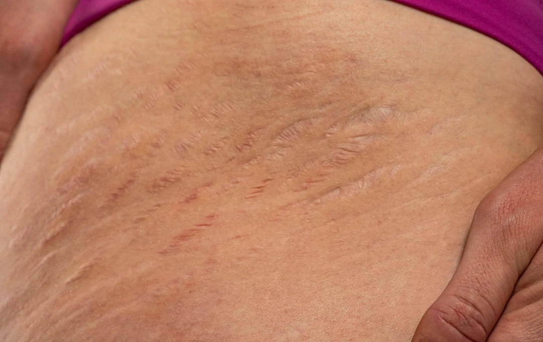 stretch marks characteristics.