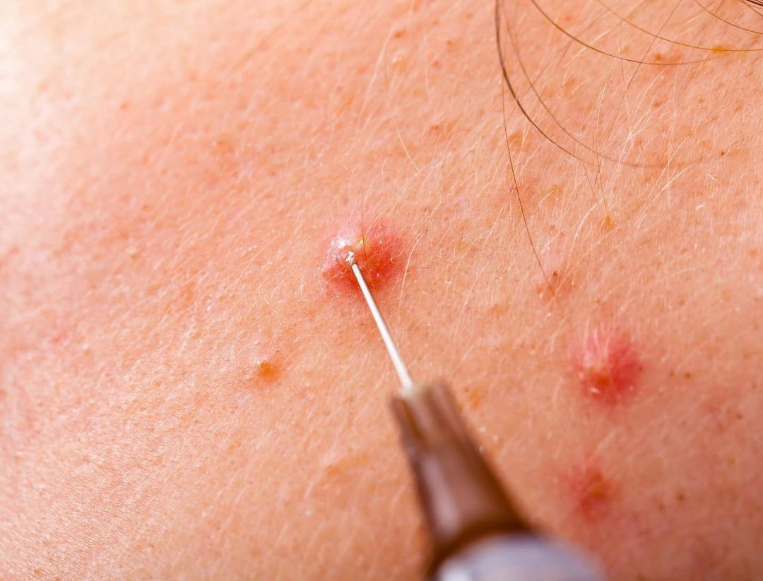 pimple injection process.