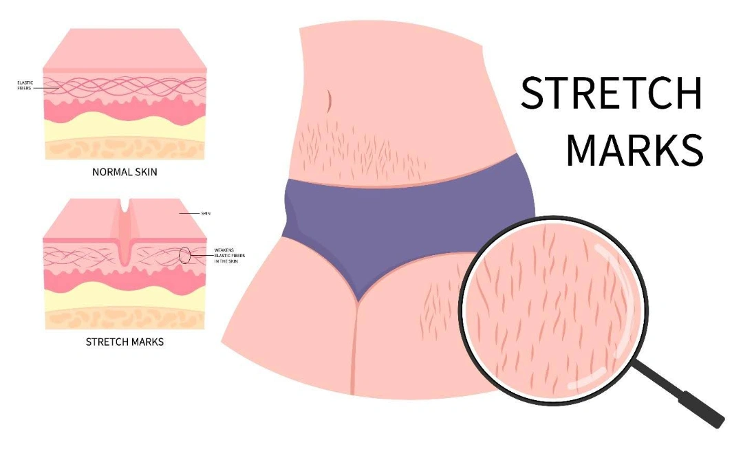 stretch marks diagnosis.