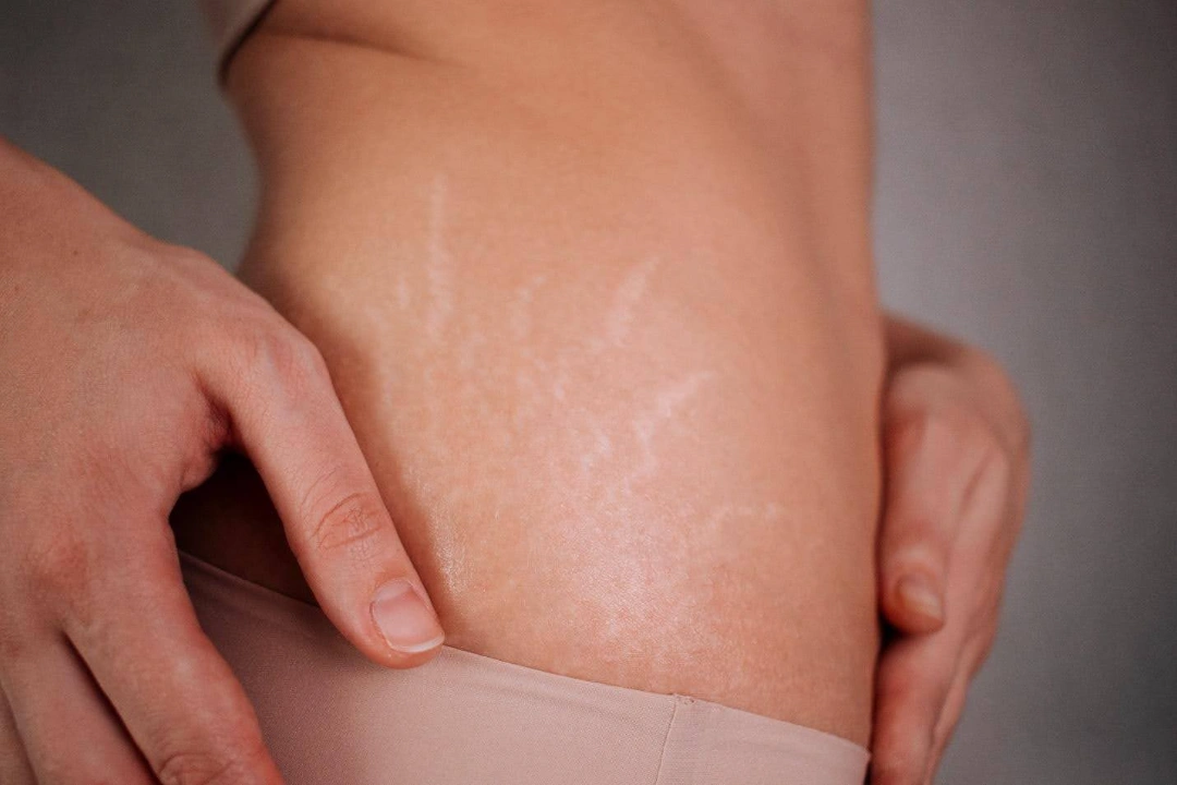 what are stretch marks.