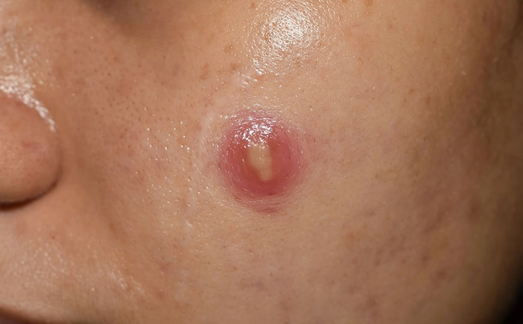 cysts abscesses Singapore.
