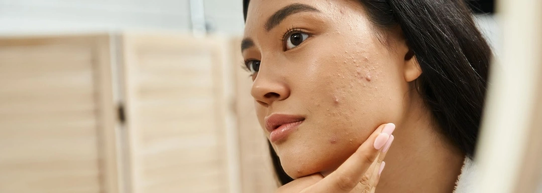 acne prone skin risk factor.