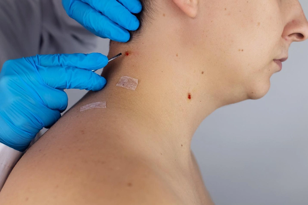 excision dermatology Singapore.