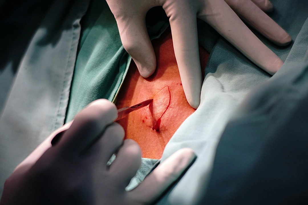 excision mole removal Singapore.