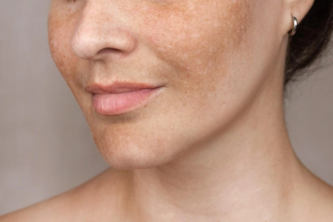 pigmentation treatment Singapore.