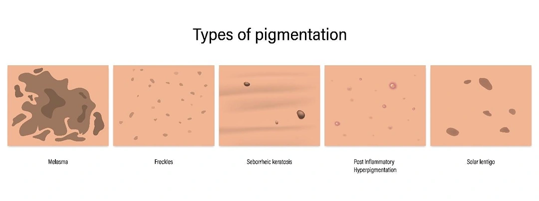 pigmentation signs and symptoms Singapore.