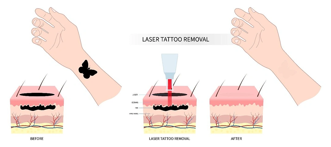 how laser tattoo removal works