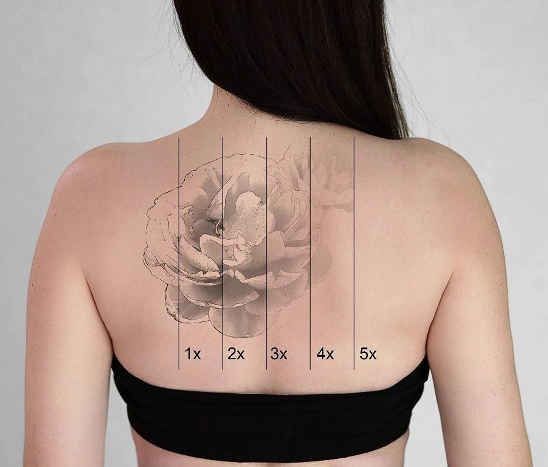 how many laser sessions for tattoo removal Singapore.