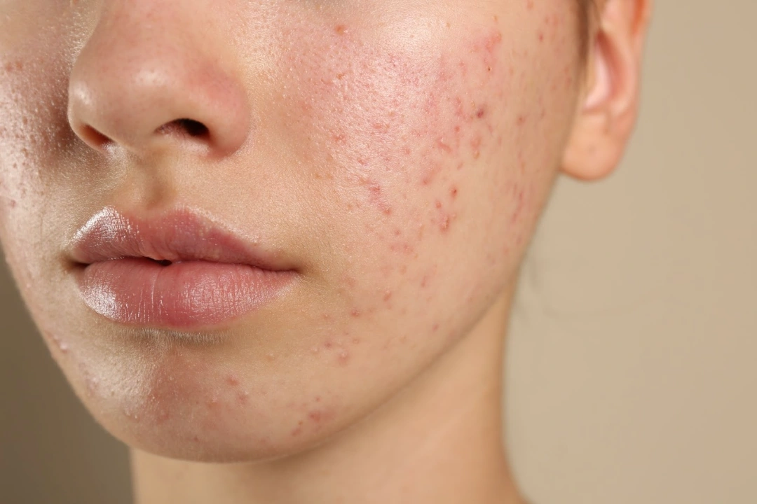 acne Singapore.