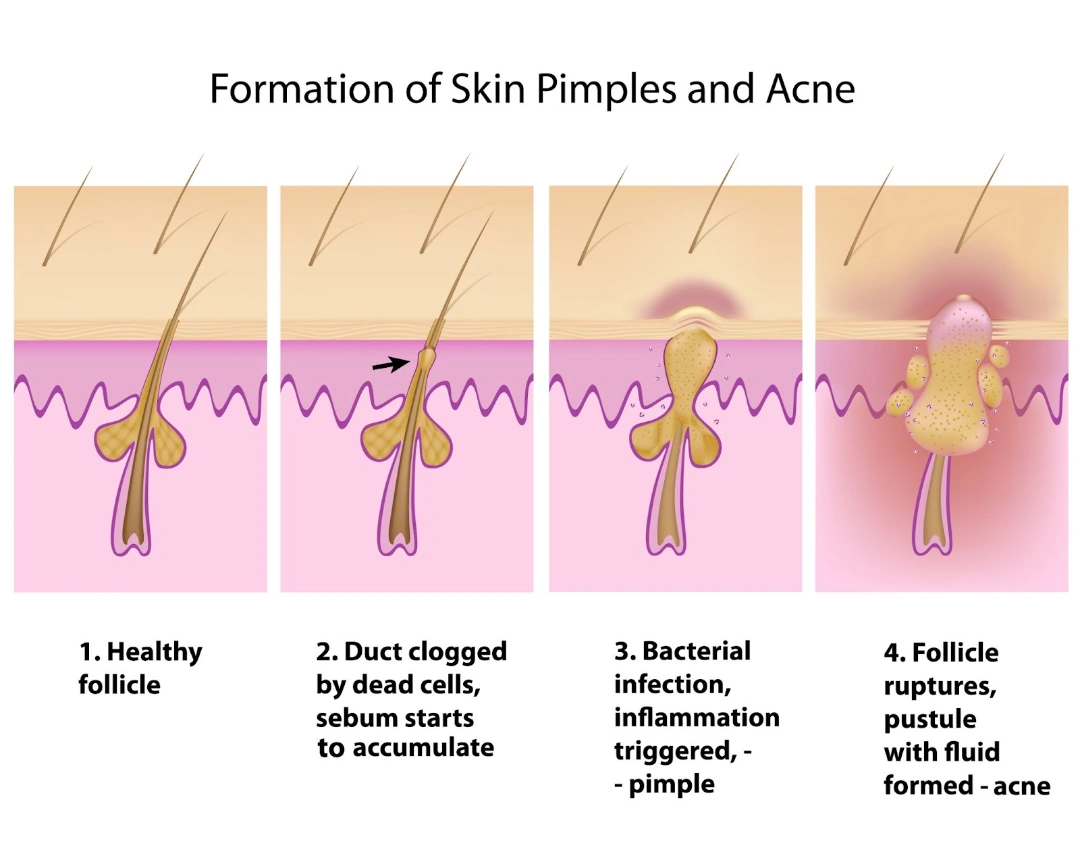 how acne if formed.