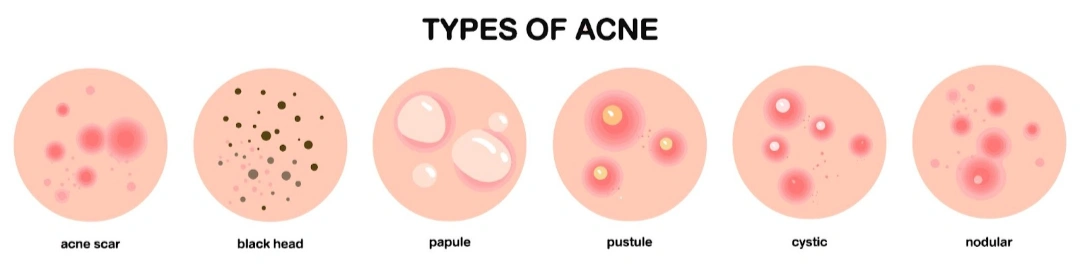 types of acne.