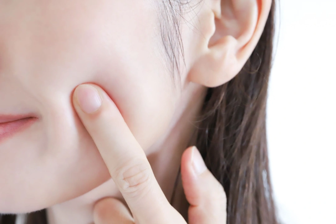 can acne be cured.