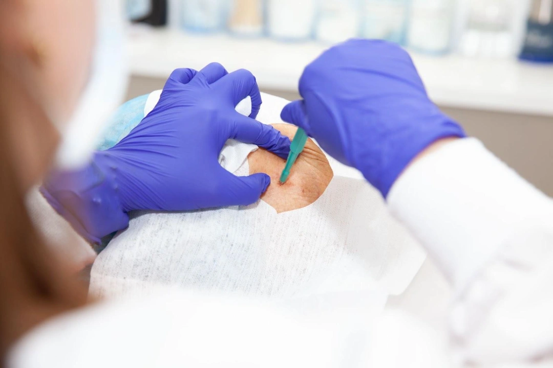 Skin Biopsy Singapore