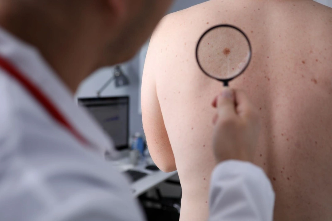 Conditions for Skin Biopsy Singapore