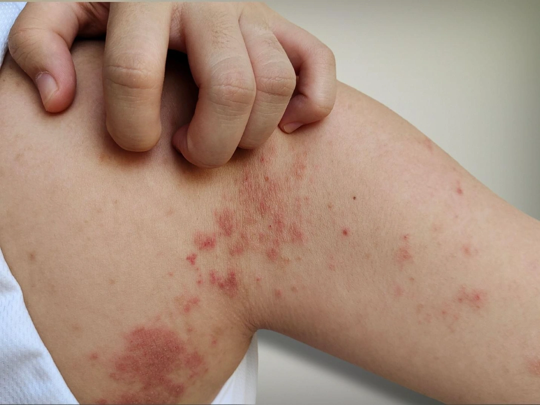 skin infections Singapore.
