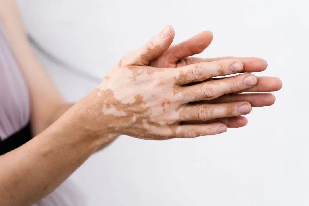 Vitiligo treatment in Singapore.