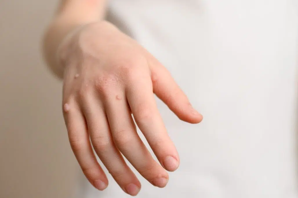 Wart and verruca treatment and removal in Singapore.