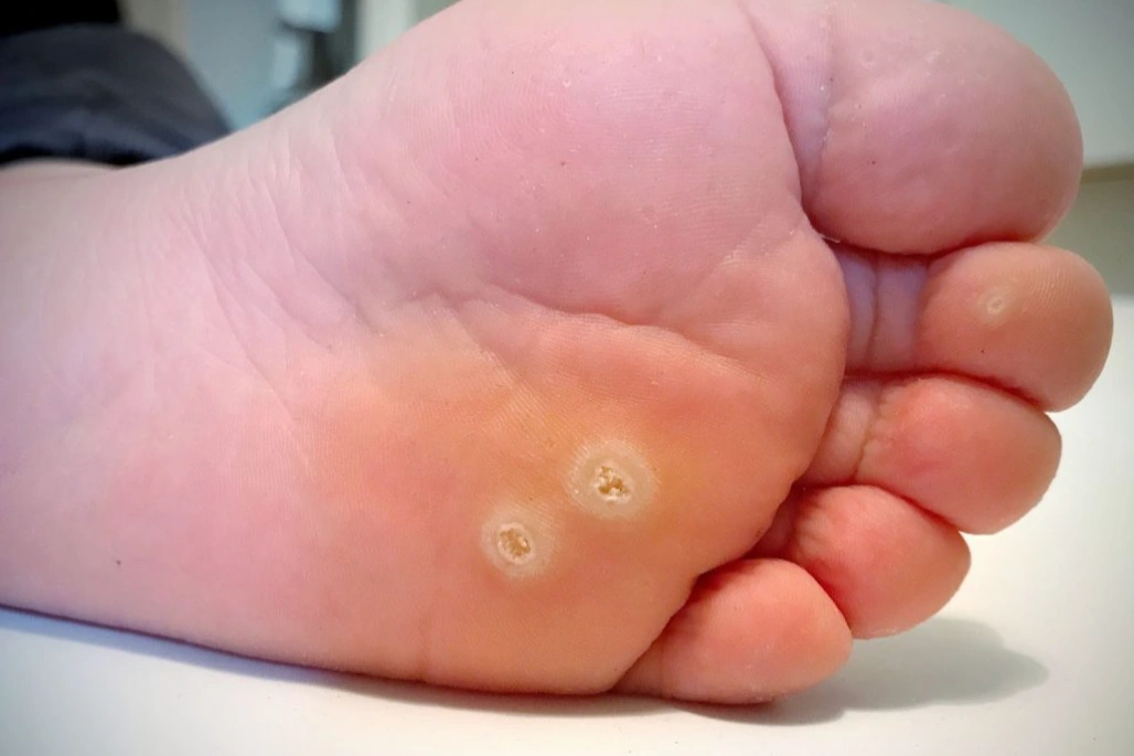 Causes of plantar warts or verrucas in singapore.