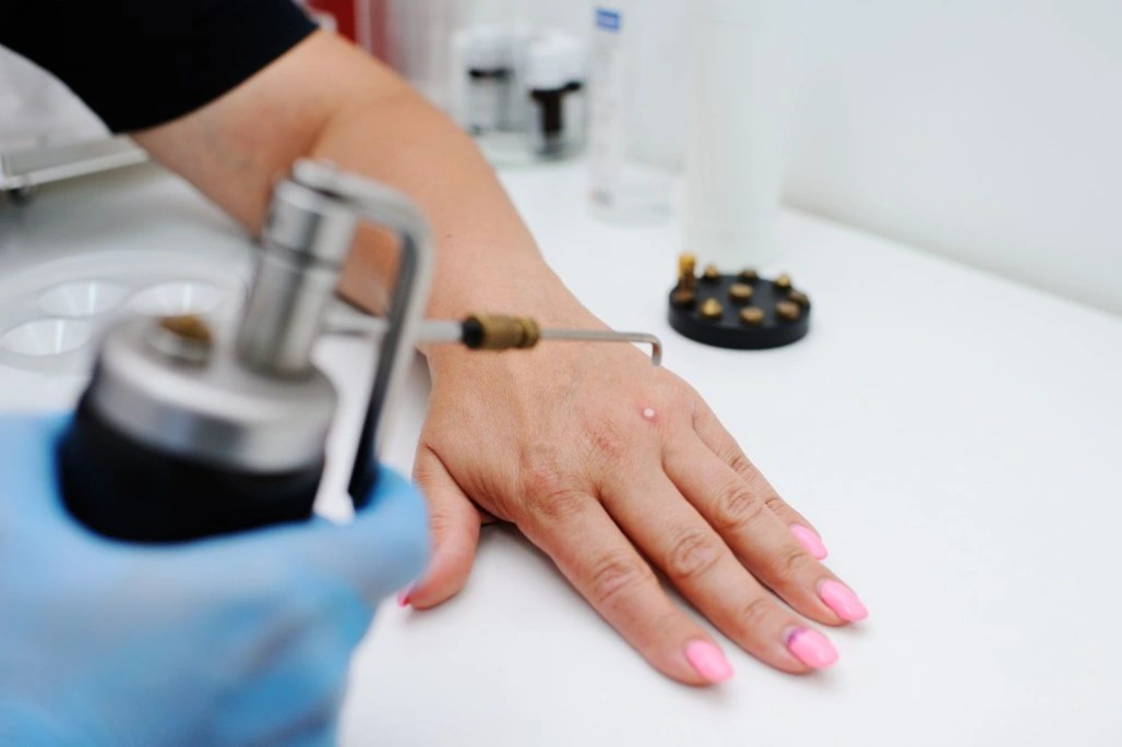liquid nitrogen treatment for warts.