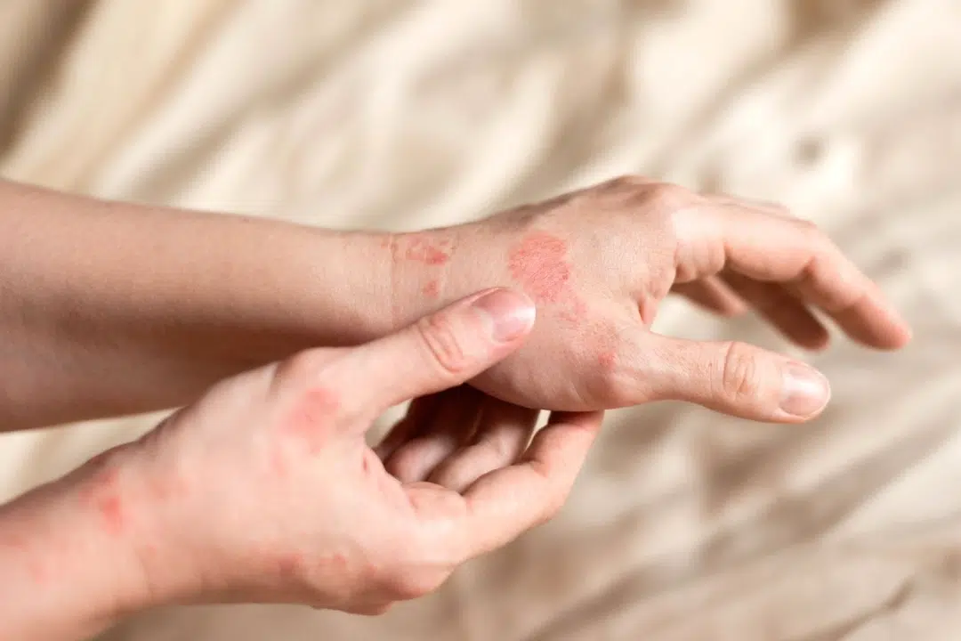 Skin allergy symptoms.