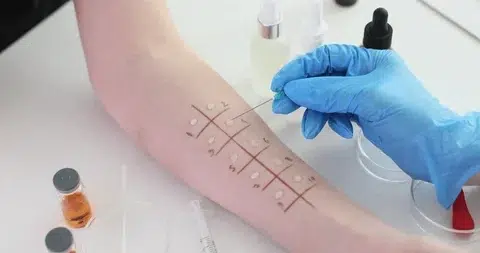 Skin prick test singapore.