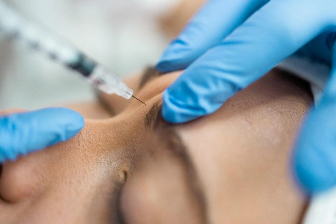 how often to repeat botulinum toxin injections