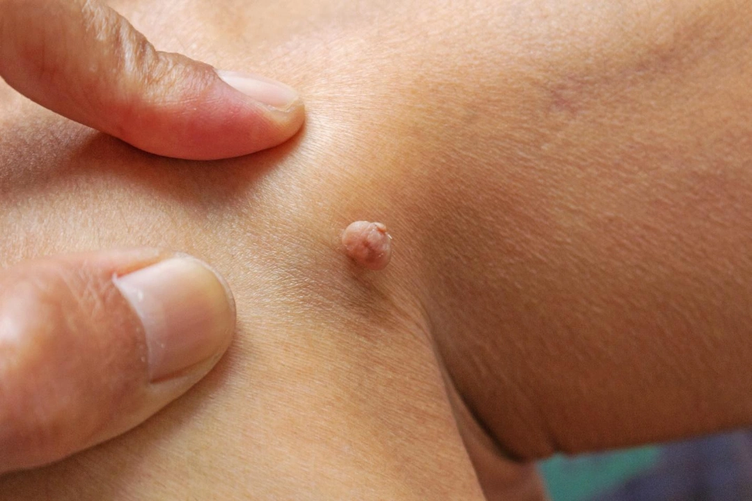 what can cold steel surgery treat