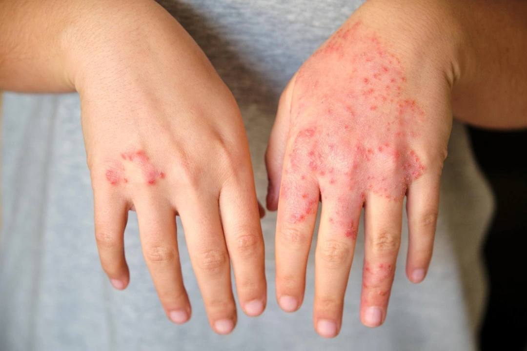 eczema Singapore
