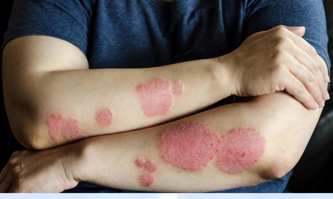 types of eczema