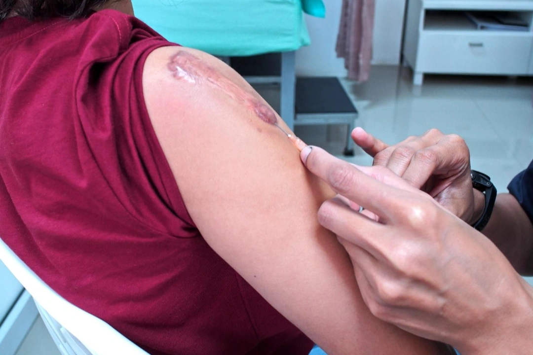 keloid scars treatment