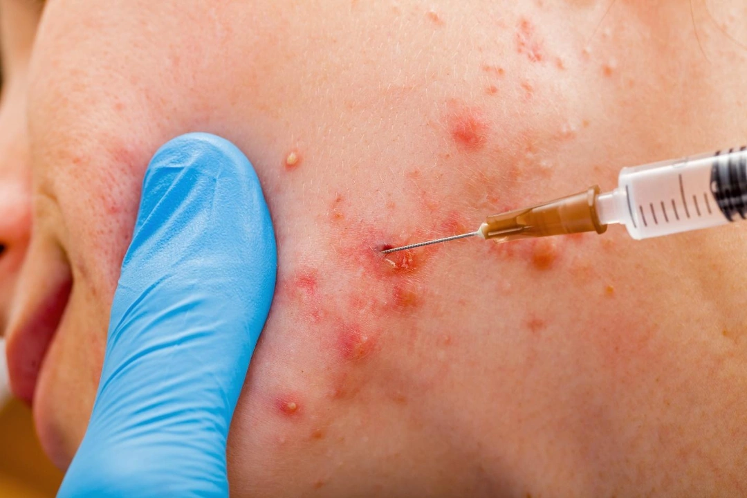treatment for cystic acne