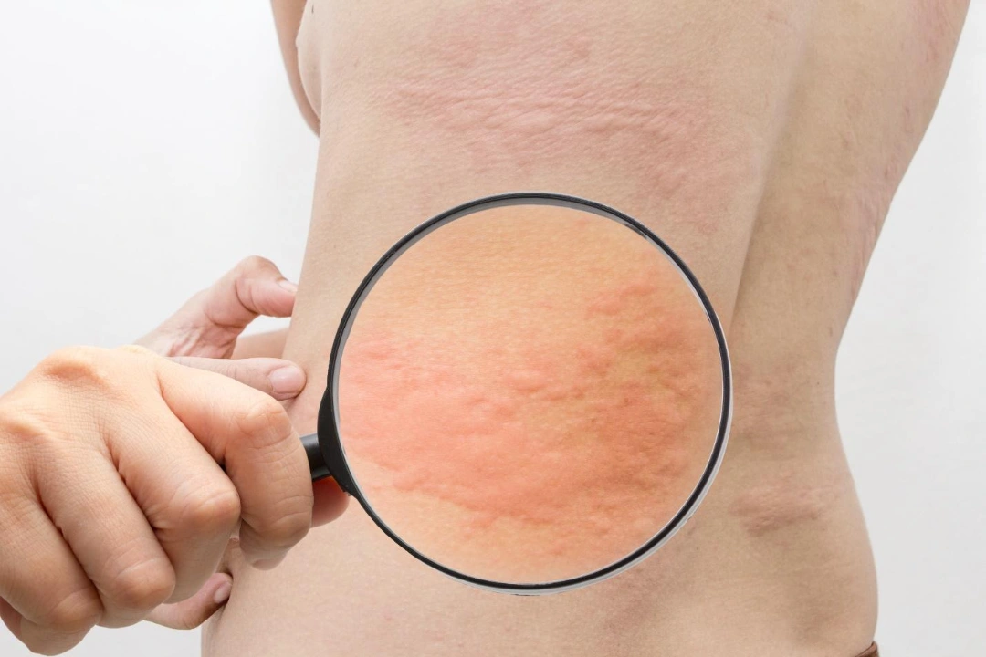 urticaria Singapore