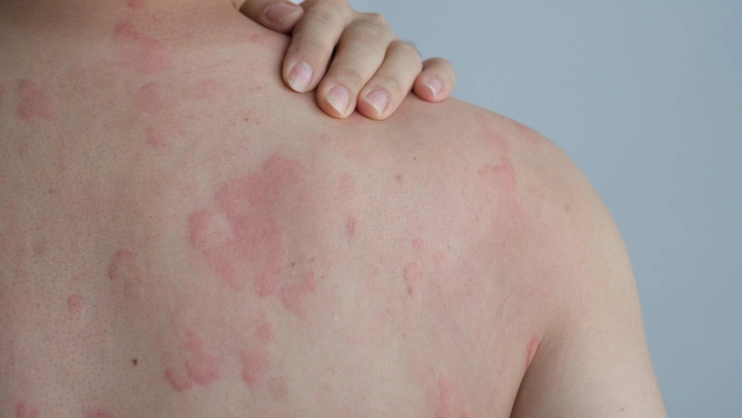 urticaria triggers.