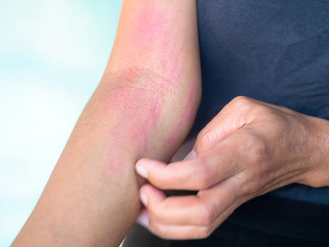 risk of urticaria in Singapore