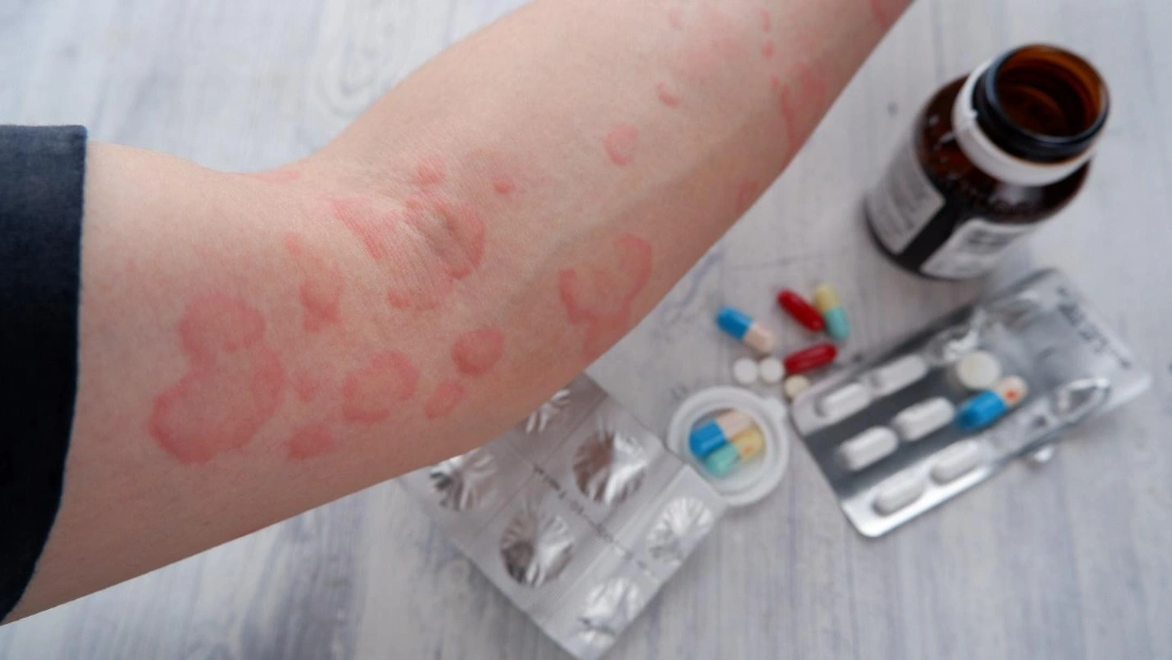 treatment for urticaria