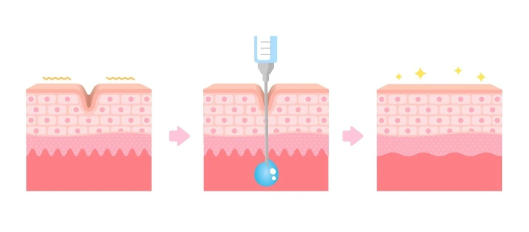 benefits of hyaluronic acid.