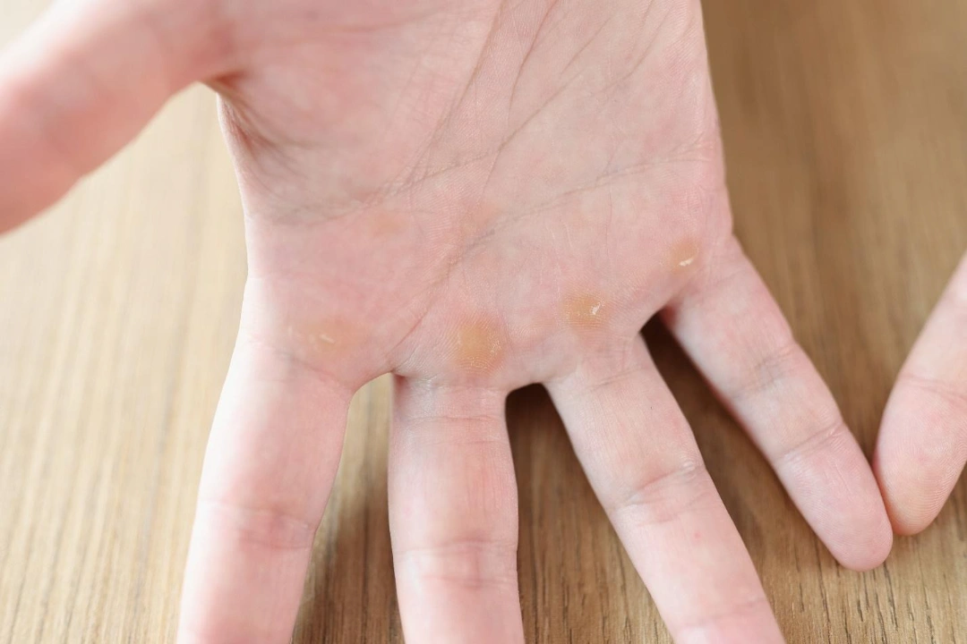 calluses on the palms.